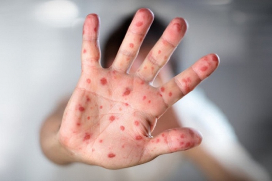 NEMA RAZLOGA ZA ZABRINUTOST Batut šalje lekarima uputstva za majmunske boginje